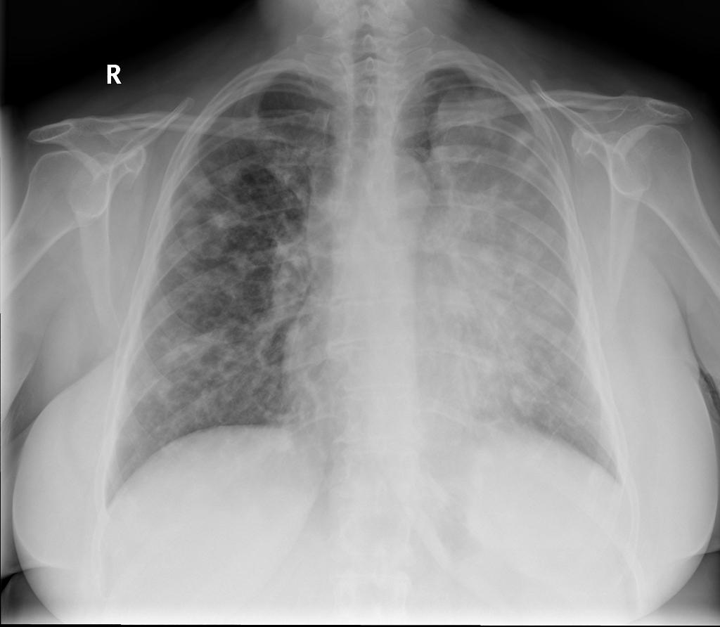 Luftsichel sign: curvilinear opacity at the left apex represents compensatory hyperinflation of the left lower lobe. Case courtesy of A.Prof Frank Gaillard. Source: Radiopaedia.org[8]