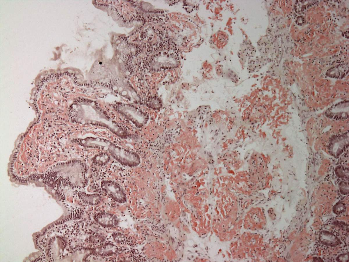 Duodenum with amyloid deposition in lamina propria.