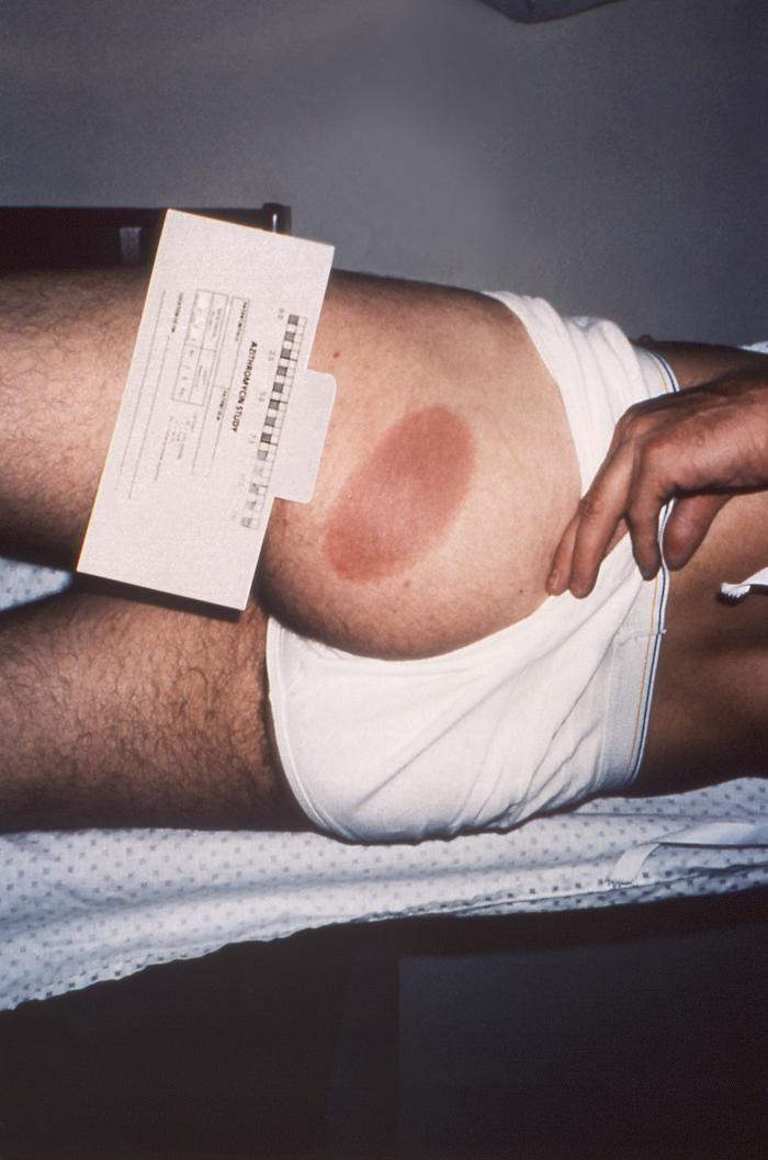 Left lateral buttock of a patient who’d presented with the erythema migrans (EM) rash characteristic of what was diagnosed as Lyme disease. From Public Health Image Library (PHIL). [2]