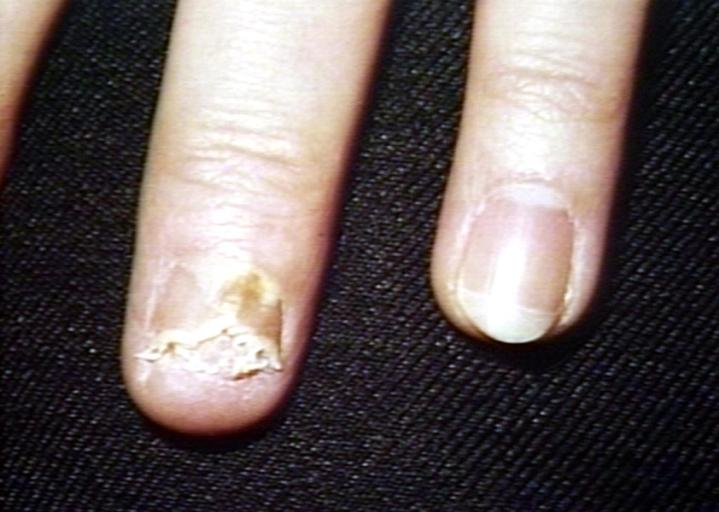 Nail changes secondary to wart.