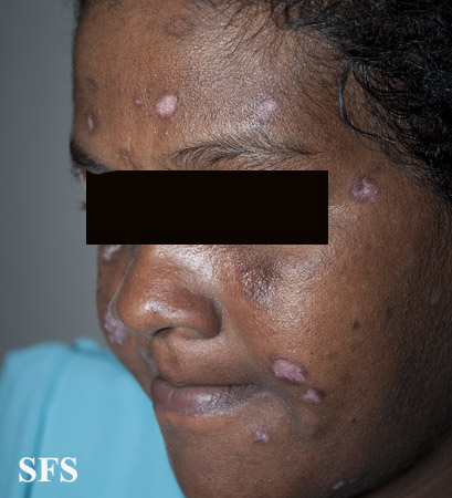 Discoid lupus erythematosus. Adapted from Dermatology Atlas.[1]