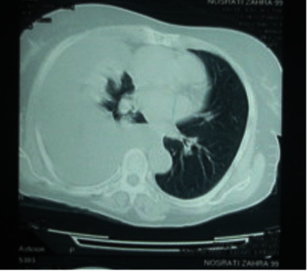 File:Struma ovarii Chest CT.jpg