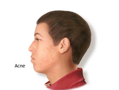 Acne is a skin condition that causes whiteheads, blackheads, and inflamed red lesions to form. These growths are commonly called pimples or "zits." Three out of four teenagers have acne to some extent.
