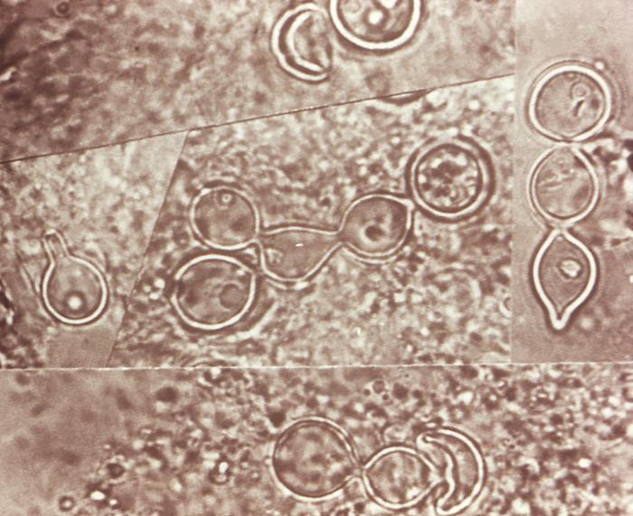 Ultrastructural histopathology in tissue specimen from a patient with a keloidean blastomycosis infection, which was caused by the fungus, Blastomyces dermatitidis. From Public Health Image Library (PHIL). [2]