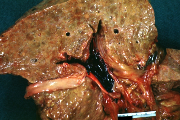 Cirrhosis with portal vein thrombosis: Gross, natural color, sectioned liver with portal vein exposed and filled with red thrombus. A good example of end stage cirrhosis.