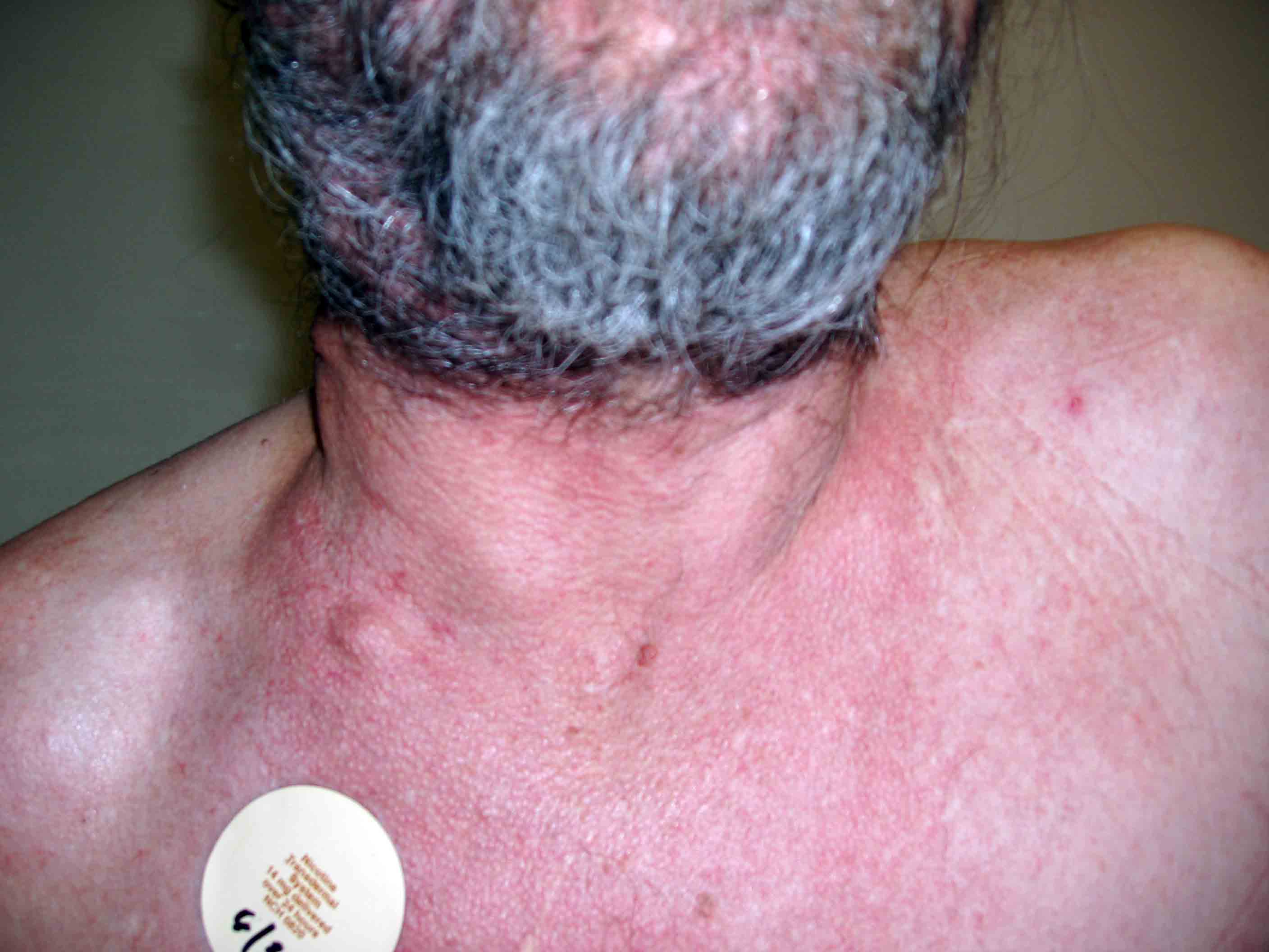 Cervical Adenopathy: multiple right sided cervical lymph nodes. Images Courtesy of Charlie Goldberg, M.D., UCSD School of Medicine and VA Medical Center, San Diego, CA.