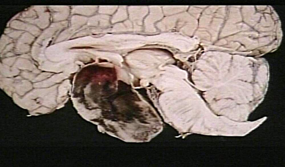 File:Pituitary adenoma with hemorrhage.jpg