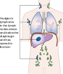 File:124px-Diagram showing stage 4 Hodgkin's lymphoma CRUK 230.svg.png