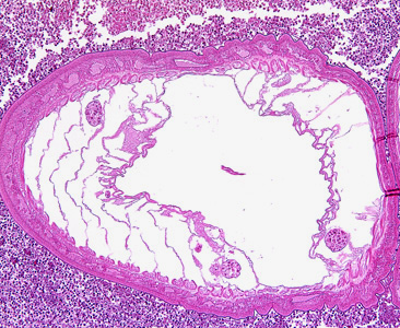 Transverse section through the body wall ofBolbosoma sp. in an intestinal biopsy specimen, stained with H&E. Image taken at 100x magnification. Cetaceans are the normal definitive hosts for Bolbosoma spp., and humans usually become infected after eating under-cooked fish which serve as paratenic hosts for the parasite. Adapted from CDC