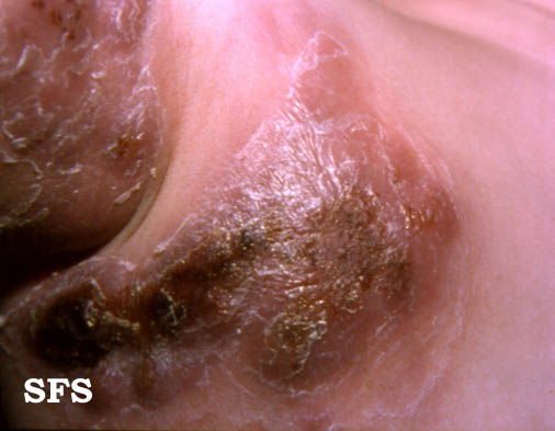 Hodgkin’s disease. With permission from Dermatology Atlas.[2]