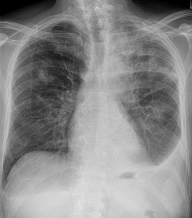 File:Legionella pneumonie Chest Xray.jpg