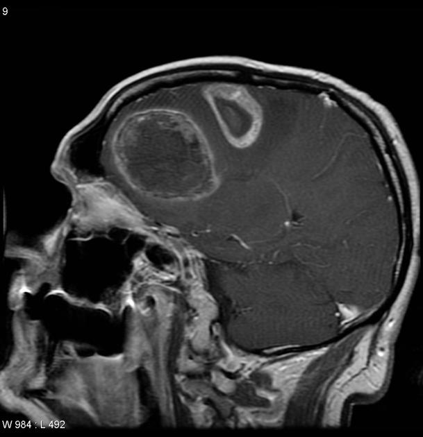 MRI head with contrast in a known case of renal cell carcinoma demonstrates multiple, large, well-defined, round, solid-cystic, peripheral irregular enhancement mass lesions involving left cerebral hemisphere and corpus callosum, crossing the midline anteriorly. Areas of necrosis and hemorrhage are seen within the lesion. Associated mass effect and moderate peritumoral edema is observed.[6]