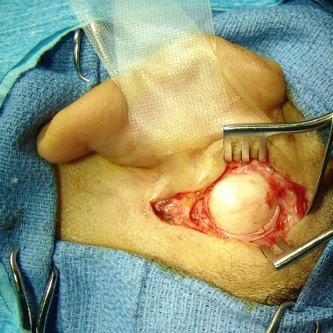 Surgical picture mastoid osteoma. The osteoma was exposed through a post-auricular incision and the periosteum was also incised and elevated [1].