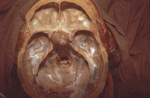 Large hyperdense sellar mass extending into the suprasellar region and causing displacement of surrounding structures. Image courtesy of Dr Gagandeep Choudhary. http://www.radiopaedia.org Radiopaedia (http://radiopaedia.org/cases/pituitary-macroadenoma). http://radiopaedia.org/licence Creative Commons BY-SA-NC.