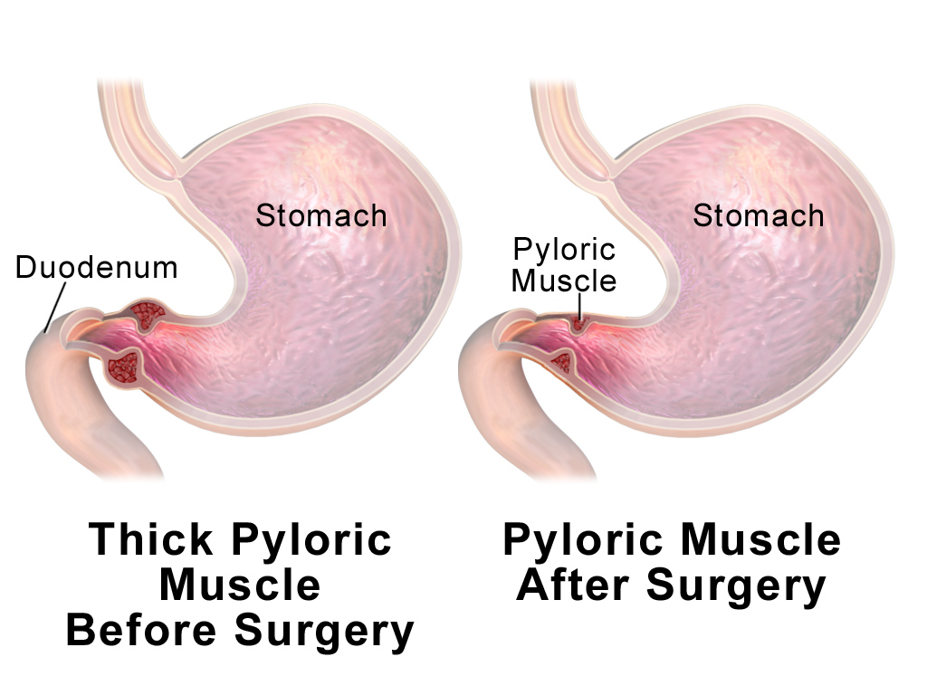 File:Pyloric Stenosis surgery.png
