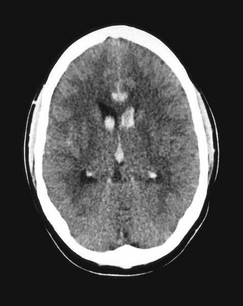 CT of the head in a patient with sickle cell disease. Shown is a subarachnoid hemorrhage.[1]