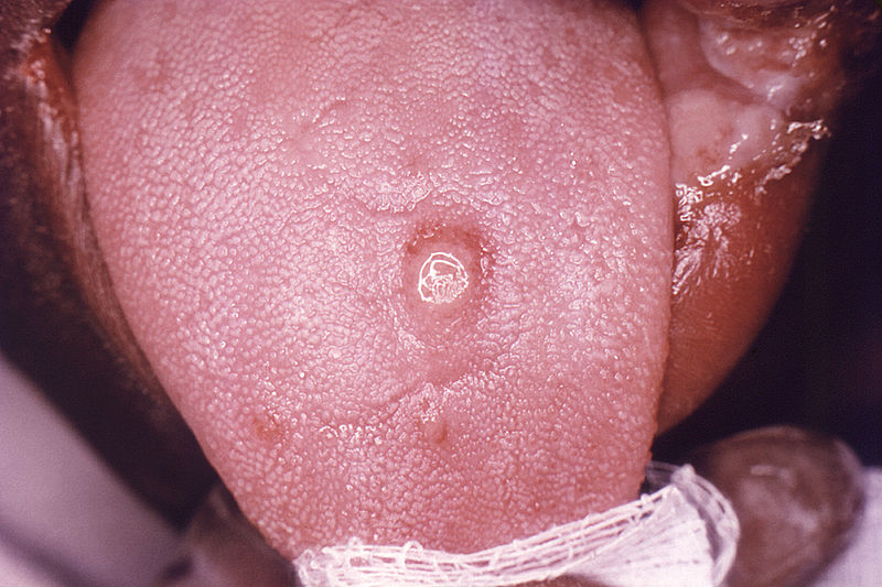 Primary stage syphilis sore (chancre) on the surface of a tongue.