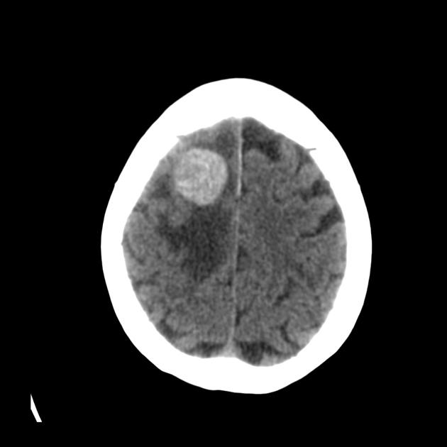 Noncontrast CT scan of a 80 year old hispanic female with known history of lung cancer, presenting with impaired consciousness, demonstrates several hypodense area of vasogenic edema in the right frontal lobe with two scattered rounded dense images.[9]