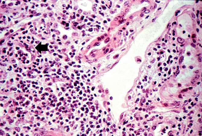 Photomicrograph from another region of previous image. Note the cellular infiltrate around a small blood vessel (right) and neutrophils within renal tubules (arrow).