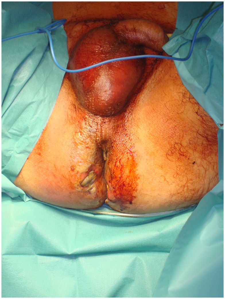 A severe case of Fournier’s gangrene with excessive erythema and edema in the perineal and gluteal regions as well as skin necrosis with bullae.[1]
