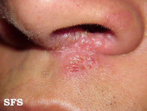 File:Herpes simplex 10.jpeg