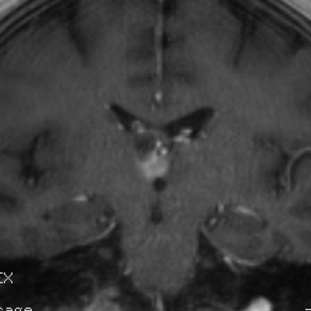 T1-weighted MRI head of a 65 year old male with advanced breast cancer demonstrates bilateral thalamic (and some smaller peripheral) metastases. The larger, partly cystic lesion on the right traverses the midline across the third ventricle.[8]