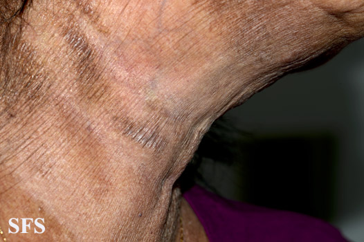 File:Mycosis fungoides 18.jpg