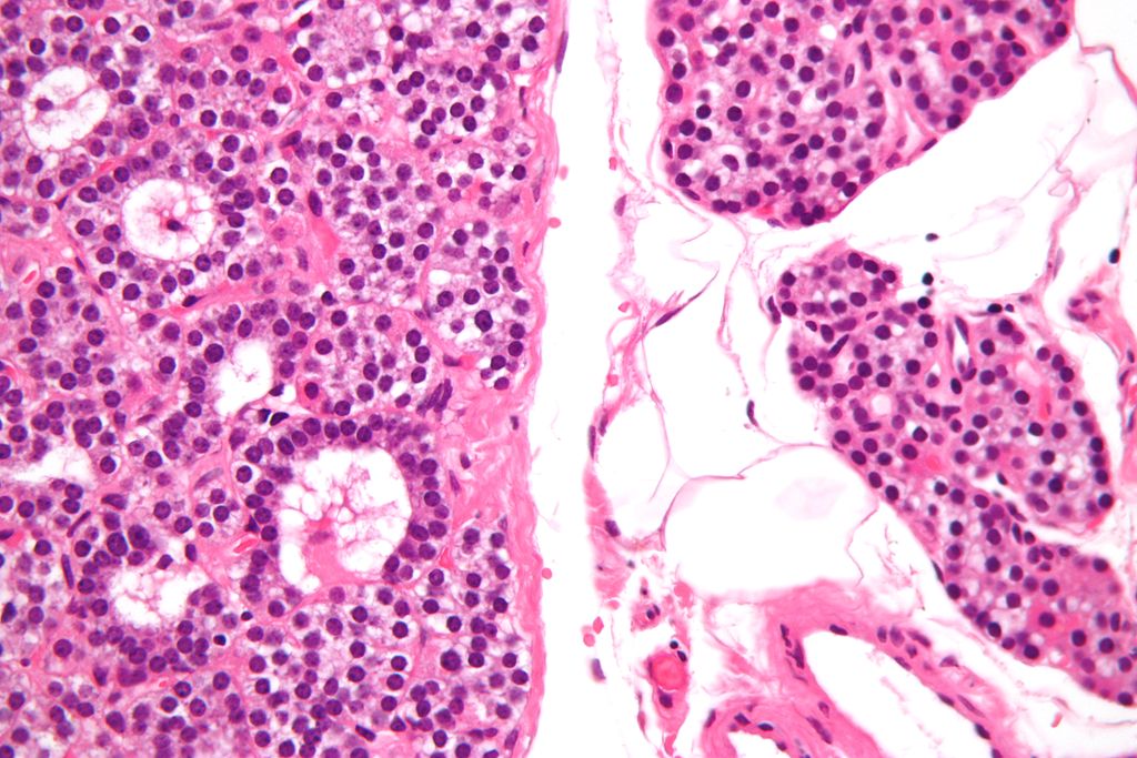 High magnification micrograph of a parathyroid adenoma. H&E stain. Features: Single cell population forming a single mass. Thin capsule. No adipose tissue. +/-Glandular architecture (which may lead to confusion with thyroid tissue). Normal parathyroid gland with prominent adipose tissue is seen on the right of the image.[5]