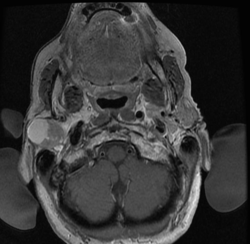 File:Pleomorphic adenoma MRI 103.jpg