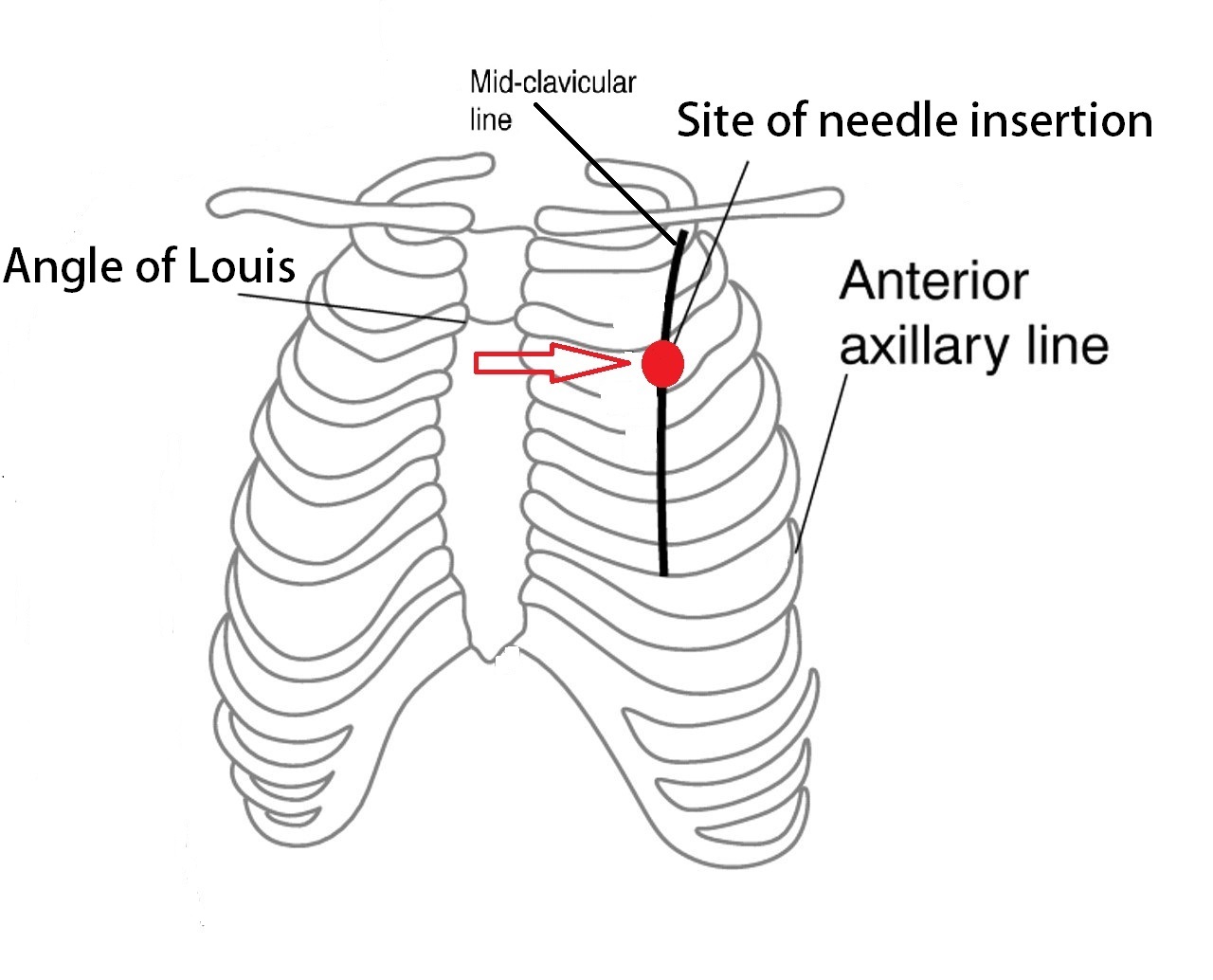 File:Site of needle insertion - 1.jpg
