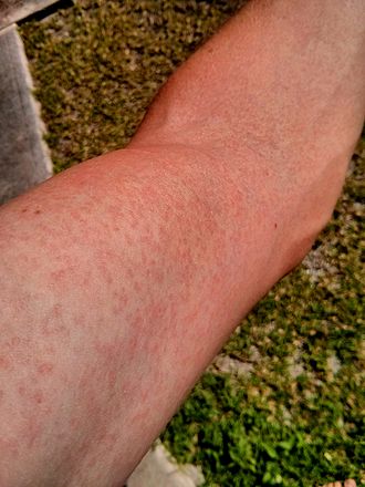 File:Zika.Virus.Rash.Arm.2014.jpg