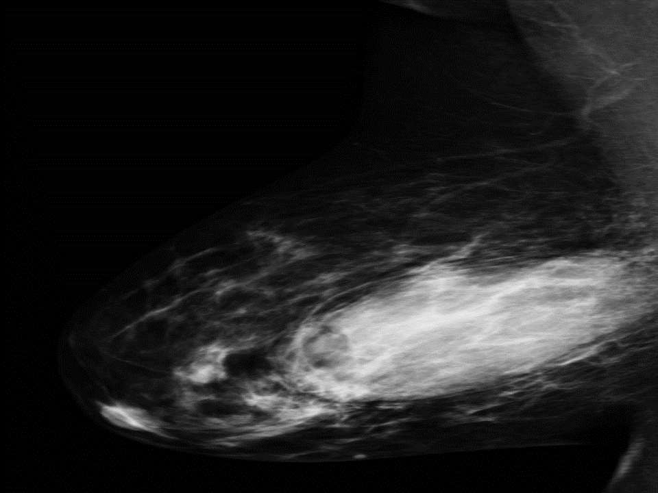 File:Breast phyllodes tumormammography.gif