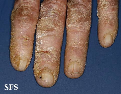 File:Darier's disease52.jpg