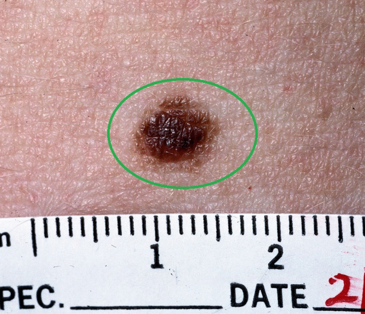 File:Epidermal nevi in Cowden syndrome.gif