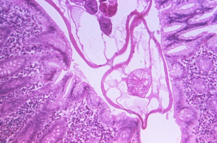 Photomicrographic study of a section of appendiceal tissue, revealed the presence of a pinworm, Enterobius vermicularis, previously Oxyuris vermicularis, which had been cut in cross-section. From Public Health Image Library (PHIL). [2]
