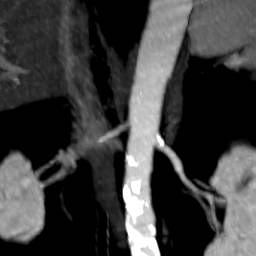 File:Renal artery stenosis 033.jpg