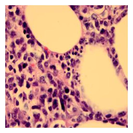 Biopsy of soft tissue : At 100x magnification with oil-immersion biopsy shows mitotic figure with scattered histiocytes and area of necrosis.[2]