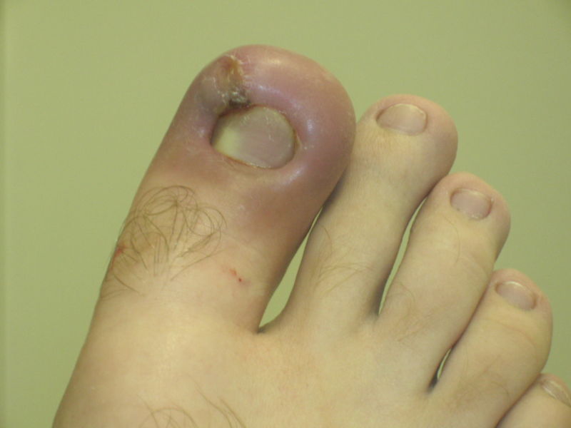 Infected ingrown toenail showing the characteristic redness and swelling associated with acute inflammation
