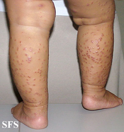 Acrodermatitis infantile papular.With permission from Dermatology Atlas.[10]
