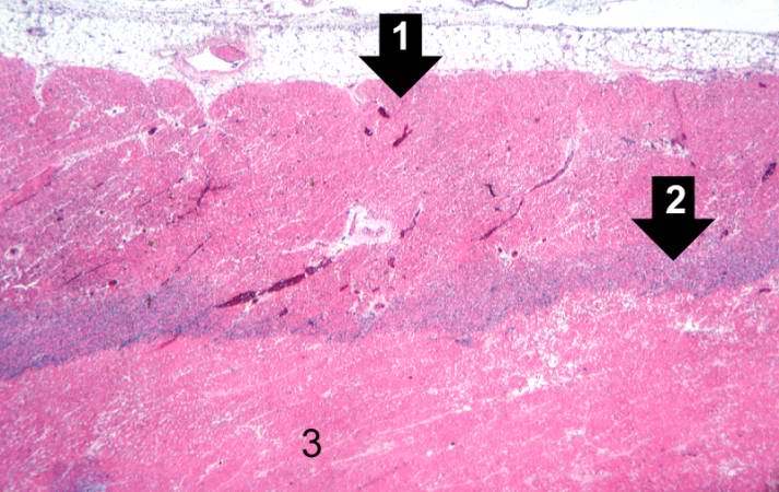 This is a higher-power photomicrograph which shows more clearly the viable tissue along the epicardium (1), the blue line of inflammatory cells (2), and the infarcted myocardium (3).