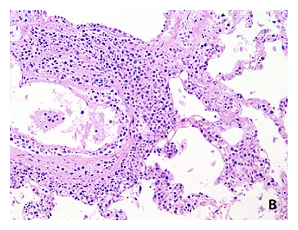 At autopsy, many of the organs showed involvement by intravascular diffuse large B-cell lymphoma.The myocardium also showed these large atypical cells in the vessel lumen.[1]