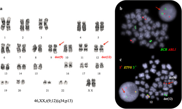 Representative Philadelphia negative metaphase bone marrow cell with a t(9;12)(q34;p13) translocation. (a) G-banded karyotype; (b) FISH analysis demonstrates lack of BCR-ABL1 fusion but reveals a small third signal from the ABL1 probe (arrow) and; (c) The ETV6 split signal (arrowed in red) on der(9)t(9;12) from the break-apart FISH probe shows the gene rearrangement and confirms G banding results. The red/green fusion signal marks the normal gene.