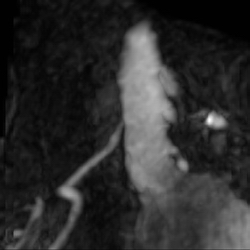 File:Renal artery stenosis 022.jpg