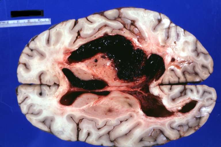 Brain: Hemorrhage: Gross fixed tissue horizontal section cerebral hemispheres with large hemorrhage in right thalamus and upper brainstem excellent example of a typical hypertensive stroke