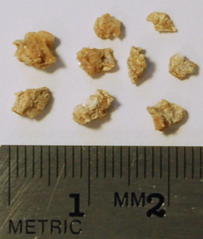 File:Kidney stone fragments.png