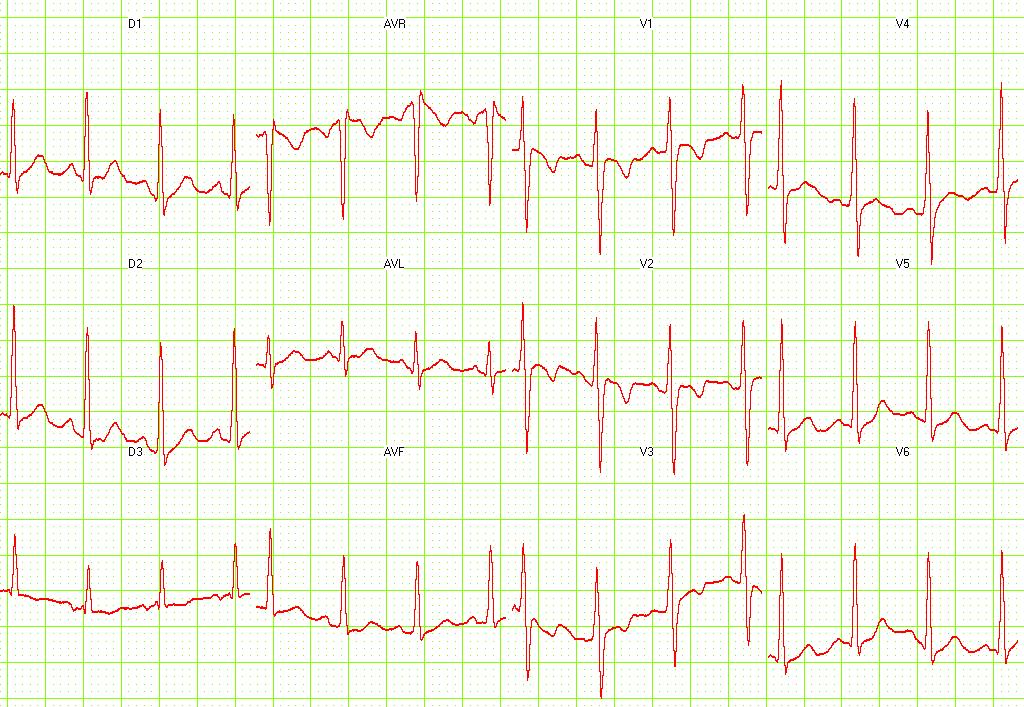 12 lead EKG shows sinusal tachycardia. The heart rate is 150 bpm Image courtesy of Dr Jose Ganseman