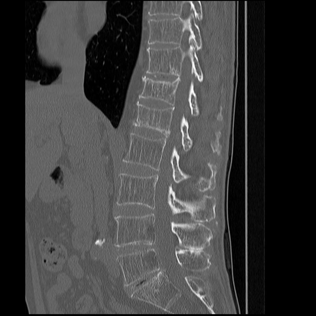 File:Vertebral-insufficiency-fractures-in-severe-osteoporosis.jpg