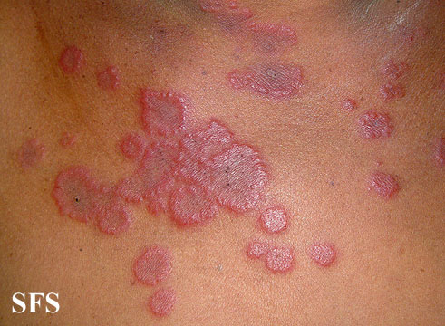 .:Erythema multiforme Adapted from Dermatology Atlas.