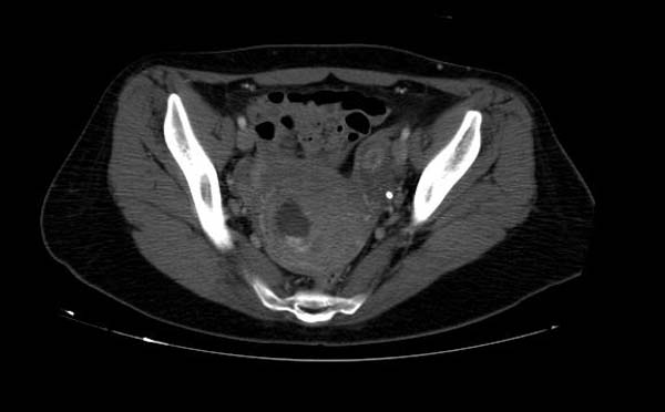 File:Gravid-uterus-CT-001.jpg