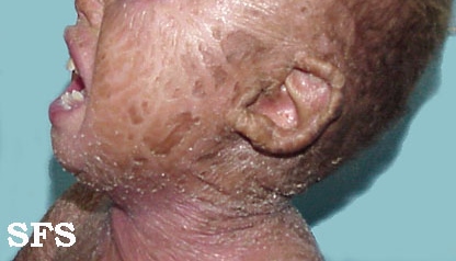 Lamellar Icthyosis. Adapted from Dermatology Atlas.[1]